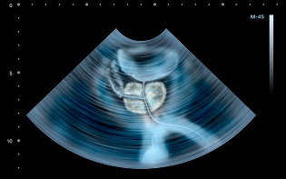 Signs of Prostatitis in ultrasound